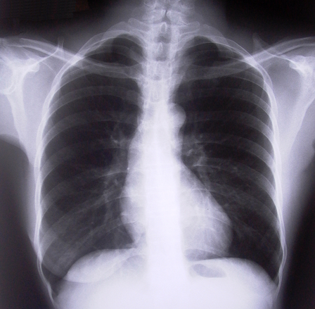 Photo of Qure.ai receives 510(k) FDA clearance for Chest X-ray solution