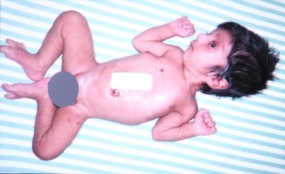 Photo of Baby born with two pairs of lower limbs  undergoes  surgery at Narayana Health City