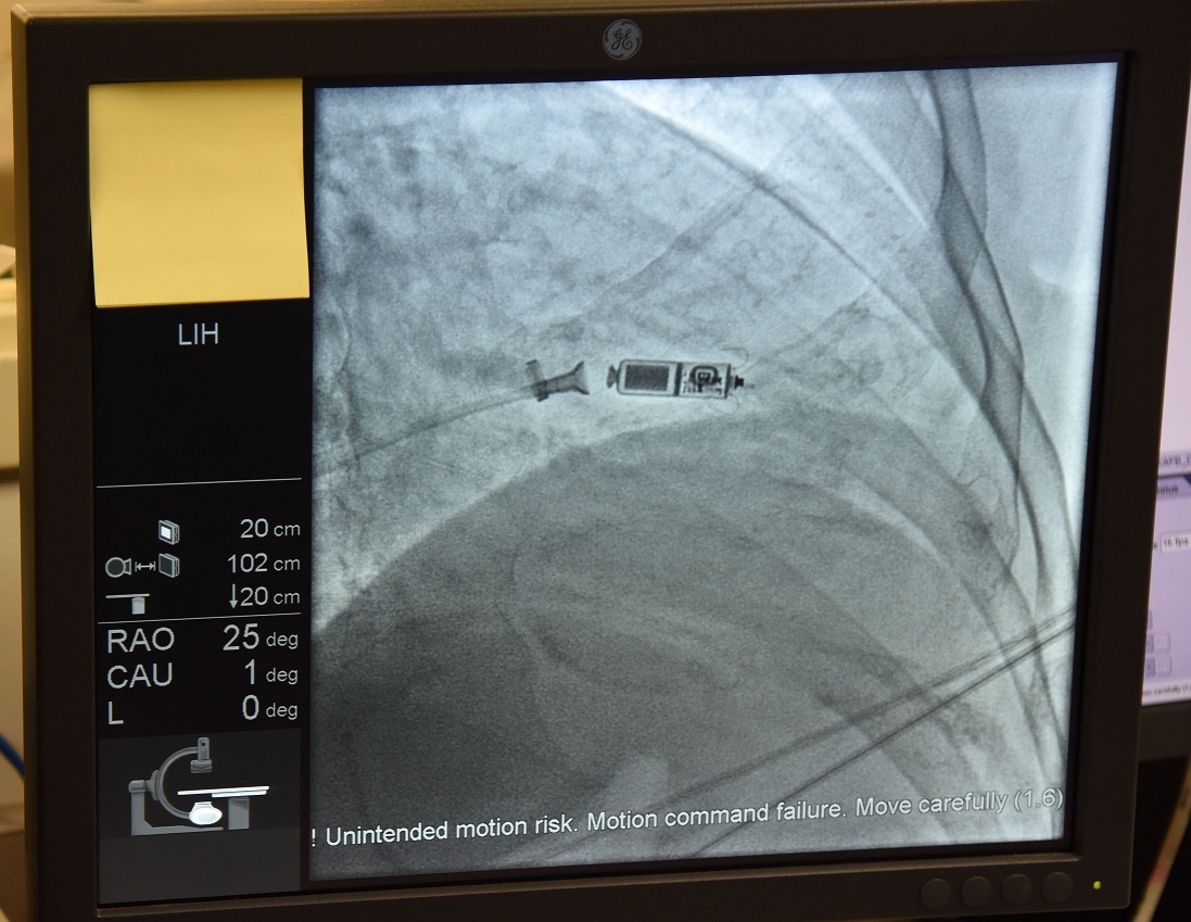 Photo of World’s Smallest Pacemaker Successfully Implanted by Saifee Hospital Surgeons
