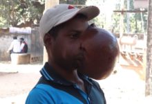 Photo of Amrita Surgeons Remove Football-size Jaw Tumor on 19-yr-old Boy