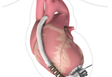 Photo of Treatment Story: World’s Smallest Heartware Ventricular Device Implanted at Fortis Malar