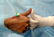 Photo of Thumb route technology enables heart treatment with same-day hospital discharge