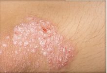 Photo of Bristol Myers psoriasis drug succeeds in late-stage study