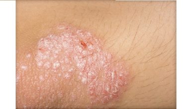 Photo of Bristol Myers psoriasis drug succeeds in late-stage study