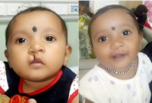 Photo of Aster CMI Hospital conducts free cleft lip and cleft palate surgeries