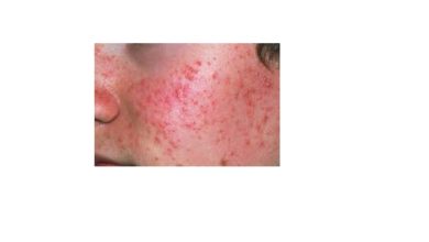 Photo of CDSCO gives nod to Glenmark’s acne drug Tazarotene