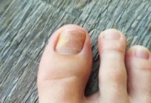 Photo of Lupin launches onychomycosis topical solution in US market