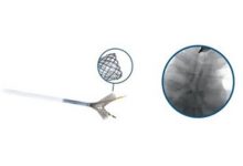 Photo of Micro-Tech Endoscopy launches self-expanding Y-Shaped tracheal stent system