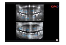 Photo of ICPA’s clinical series explores regenerative periodontal surgery in current day practice